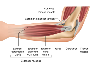 Tennis Elbow – Lateral Elbow Tendinopathy condition photo